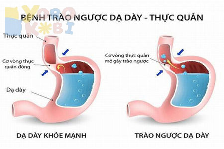 Hình ảnh nhóm sản phẩm Trào ngược dạ dày nguyên nhân, triệu chứng và cách điều trị