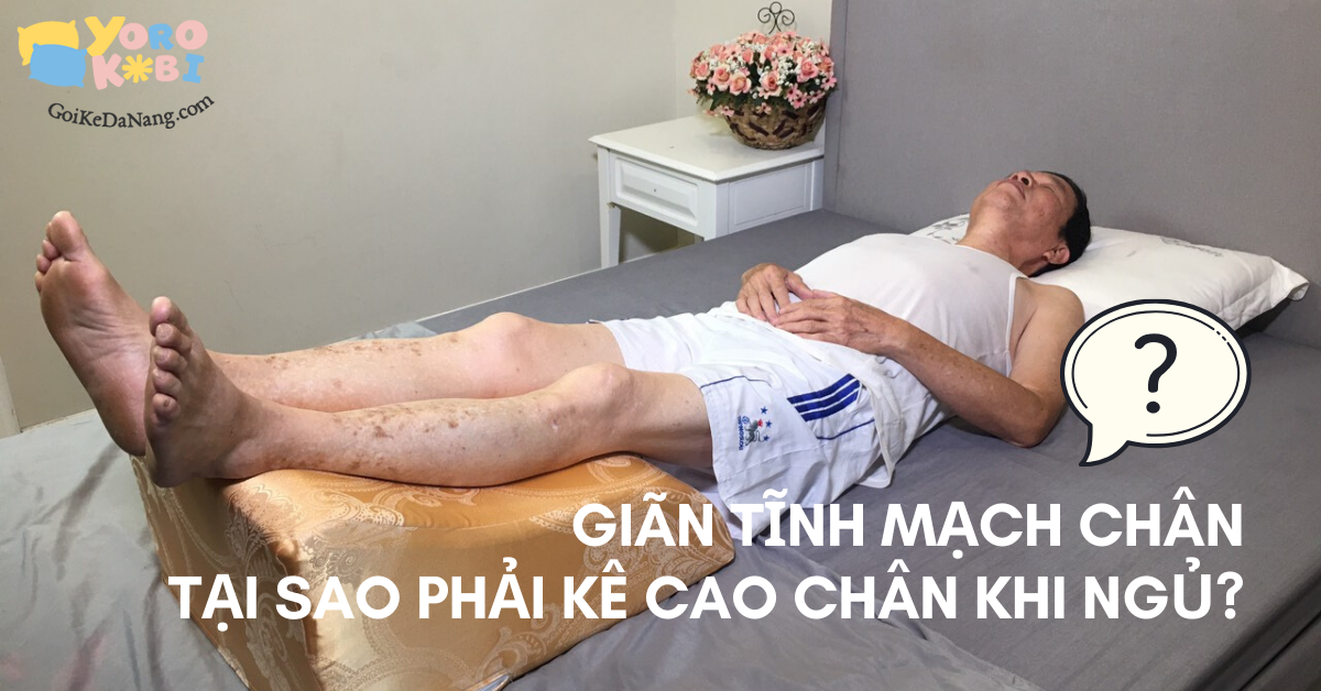 Tại sao giãn tĩnh mạch chân phải kê cao chân khi ngủ?