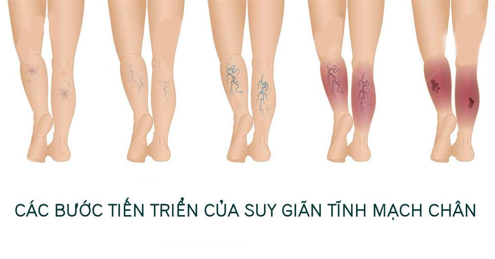 các cấp độ suy giãn tĩnh mạch