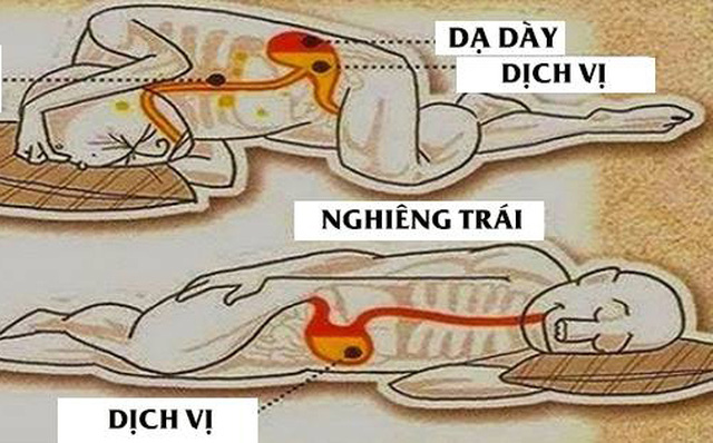 Trào ngược dạ dày khi ngủ nên nằm nghiêng sang trái